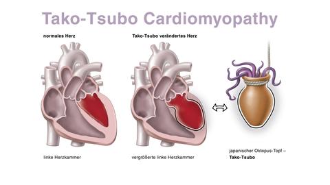 Darstellung des Broken-Heart-Syndrom