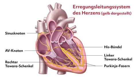 Bild von dem AV-Block